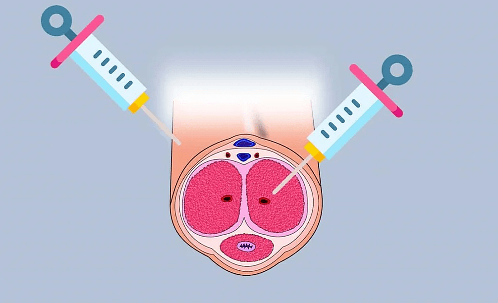 places for hyaluronic acid injection