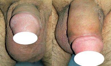 PHOTO before and after boosting penis
