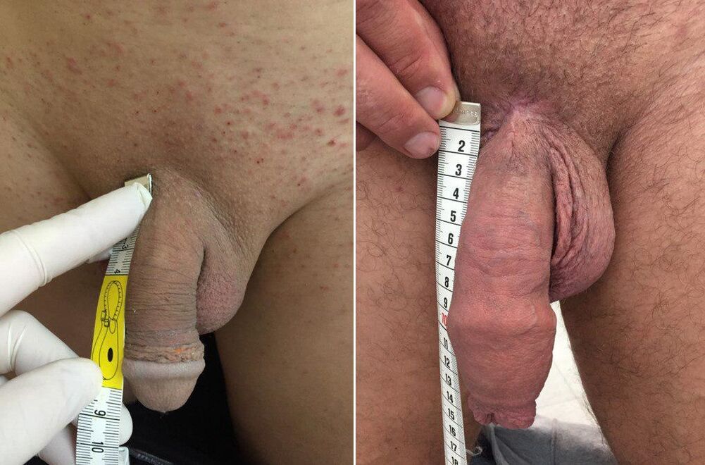 before and after penis enlargement