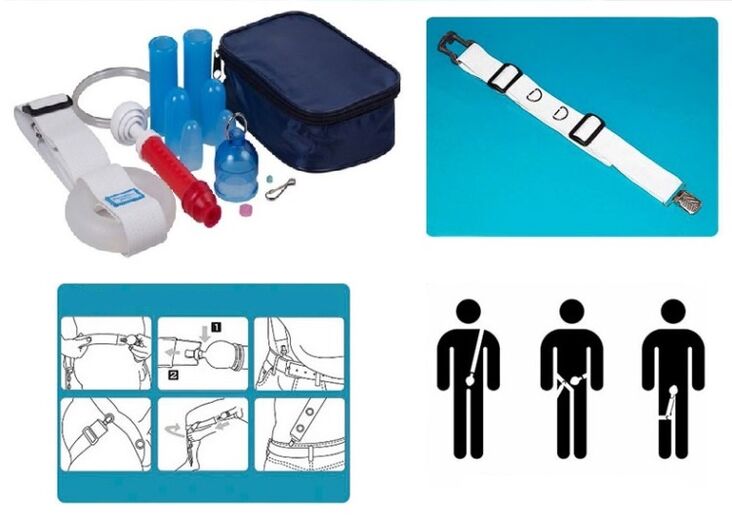 Elongation and enlargement of the penis can be achieved with a stretcher